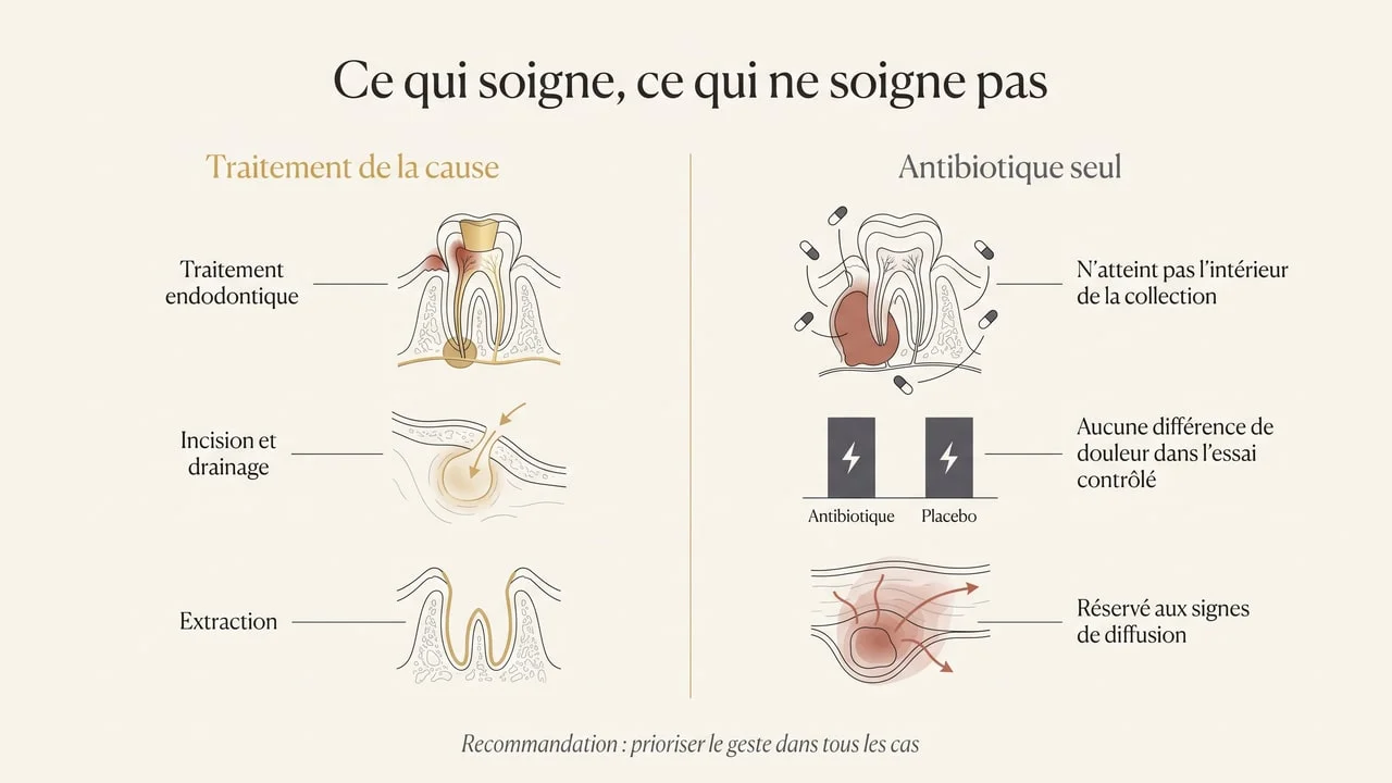 Diagramme opposant les traitements qui suppriment la cause d'un abcès dentaire — endodontie, drainage, extraction — à l'antibiothérapie seule, réservée aux signes de diffusion