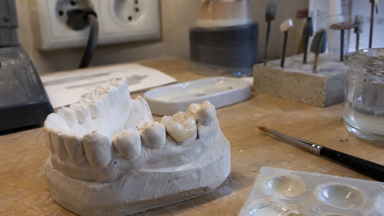 Un onlay en céramique vitreuse posé sur un modèle en plâtre de molaire, sur l'établi d'un laboratoire de prothèse dentaire