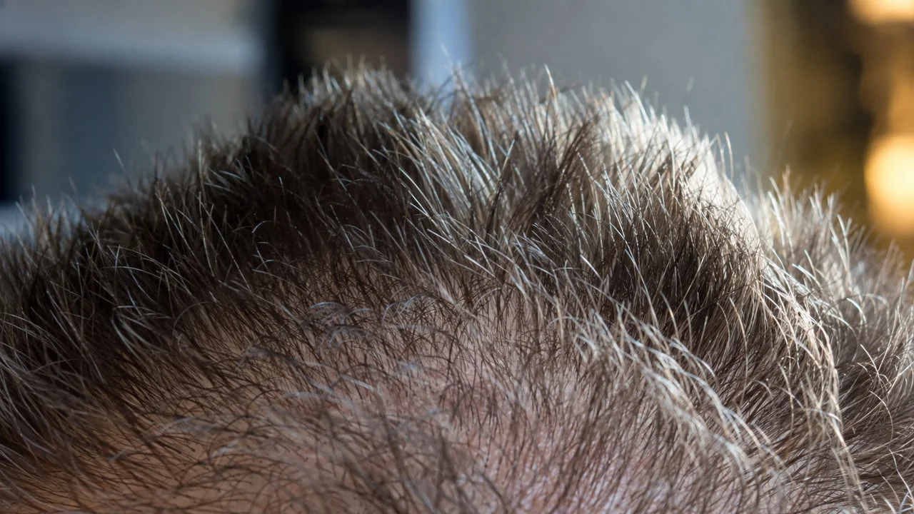 Gros plan macro de cheveux courts de deux à trois centimètres se tenant droits sur le cuir chevelu