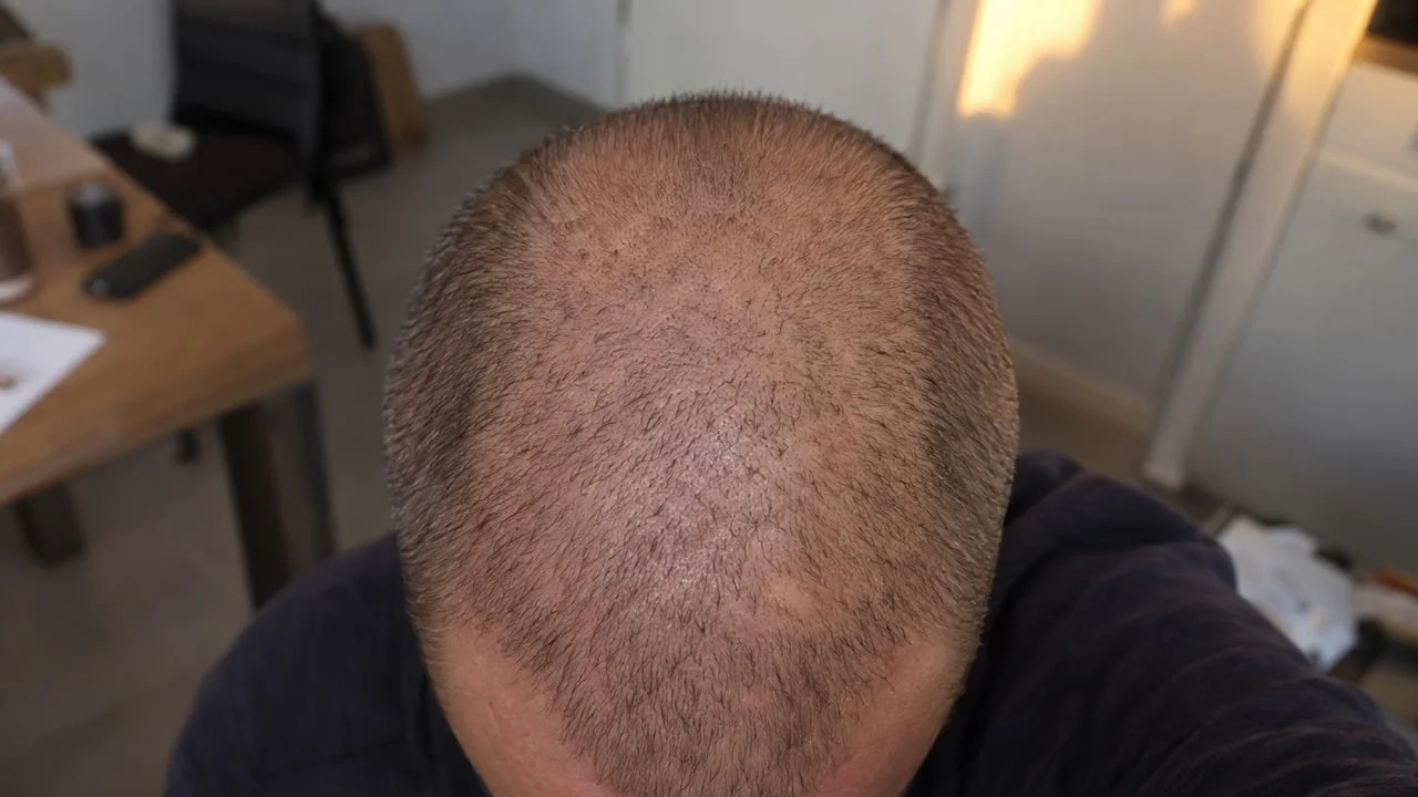 Dessus du crâne au premier mois : peau nette, cheveux très courts, aucune repousse encore visible