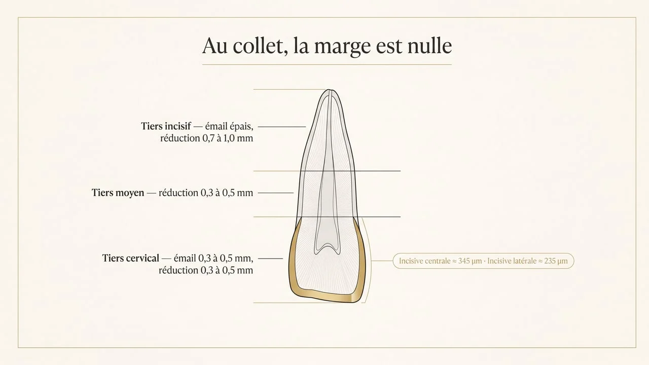 Coupe schématique d'une incisive montrant l'épaisseur d'émail disponible au tiers cervical comparée à la réduction nécessaire pour une facette dentaire