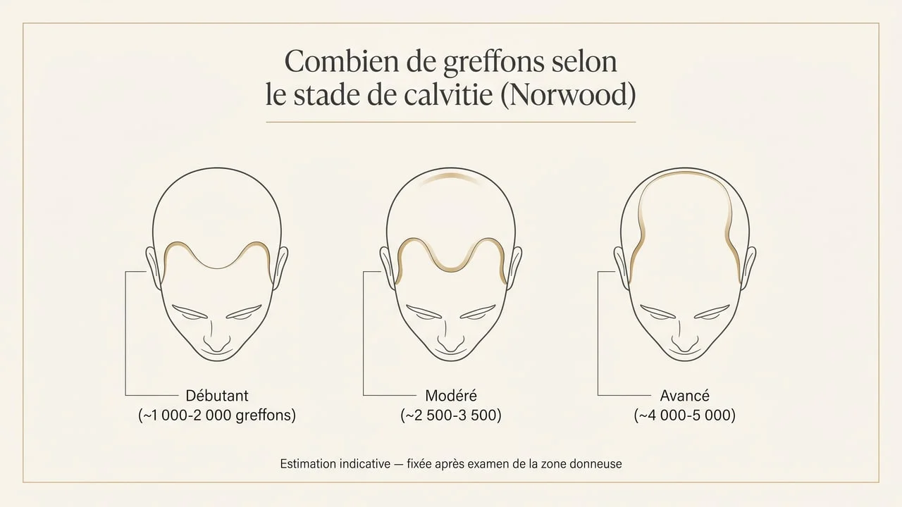 Schéma du nombre de greffons nécessaires selon le stade de calvitie de Norwood : débutant 1 000-2 000, modéré 2 500-3 500, avancé 4 000-5 000