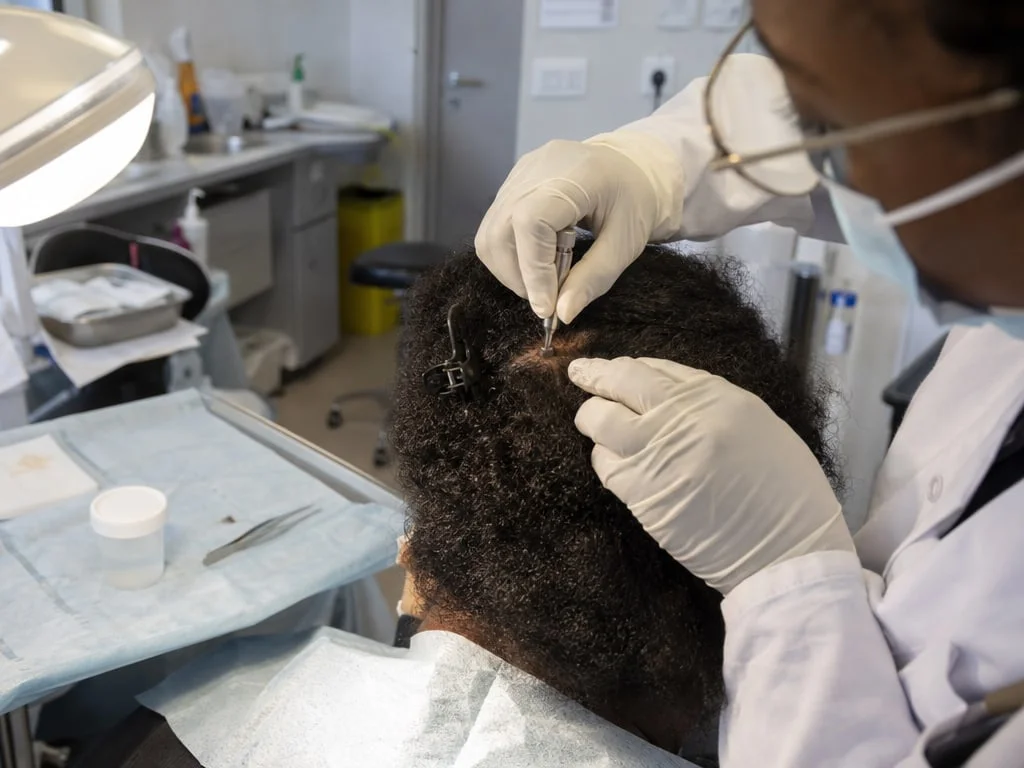 Prélèvement d'une biopsie du cuir chevelu au punch au sommet du crâne d'une patiente aux cheveux crépus