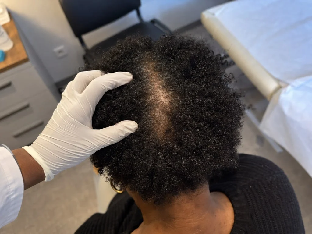 Sommet du crâne aux cheveux crépus, raie centrale élargie et densité plus faible au centre du vertex