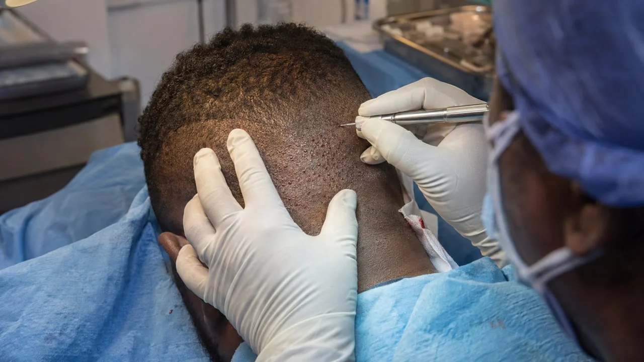 Prélèvement folliculaire unitaire en zone occipitale sur un cuir chevelu à la peau foncée, sites de ponction visibles