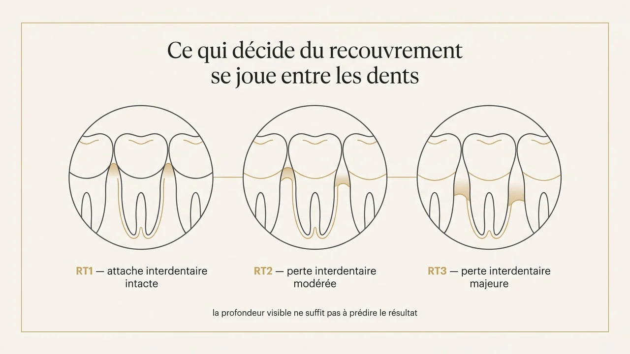 Schéma des trois types de récession gingivale RT1, RT2 et RT3 selon le niveau d'attache interdentaire